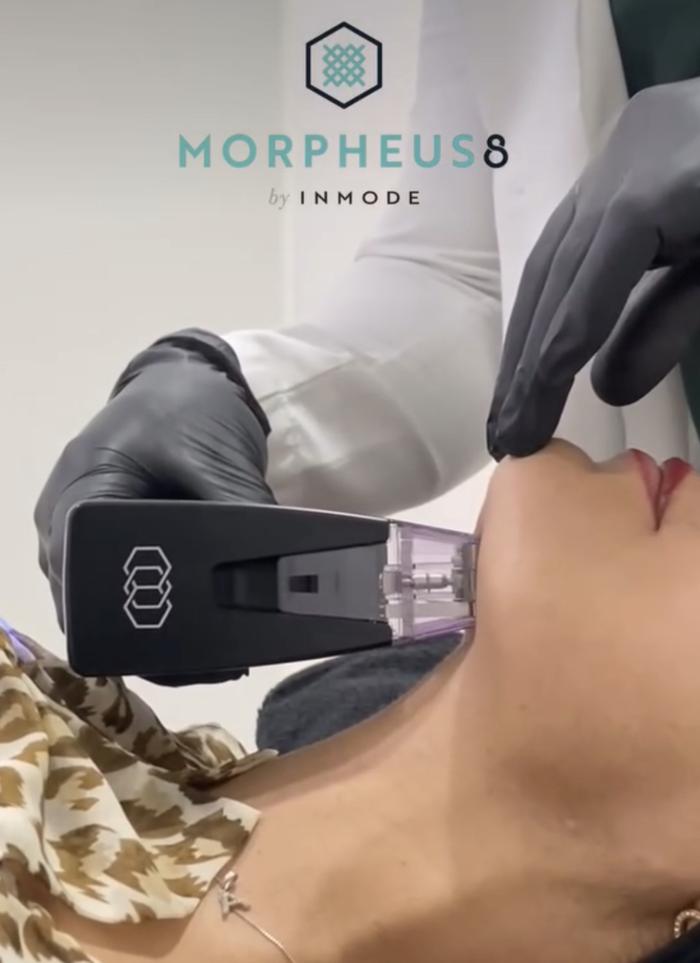 Morpheus8 facial